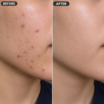 AcnoChem Serum